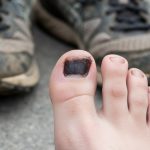 Gros plan sur un ongle de pied noir, illustrant les causes non traumatiques.